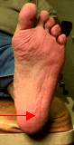 heelbursitis.gif (11007 bytes)