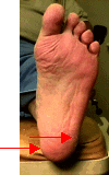 heelneuritis.gif (11277 bytes)